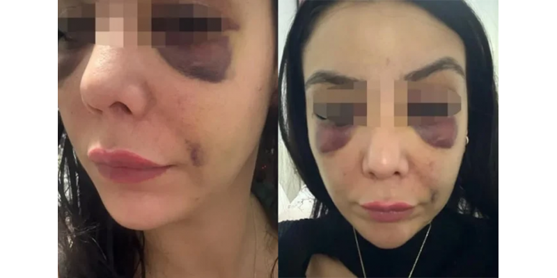 Konya’da Kick Boksçu Genç Kadını Yumruklayarak Bayılttı