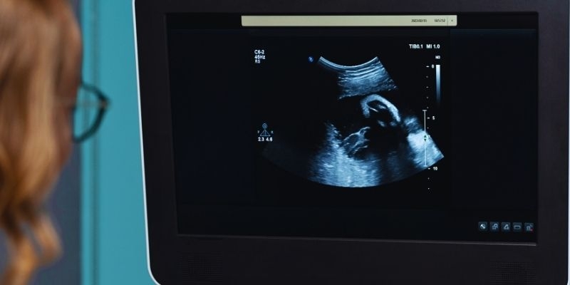Doktorlara Karın AÄŸrısıyla Gitti 35 Yaşında "TaÅŸ Bebek" Fetüsü Çıktı